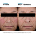 Before and after results of using SkinCeuticals Redness Neutralizer