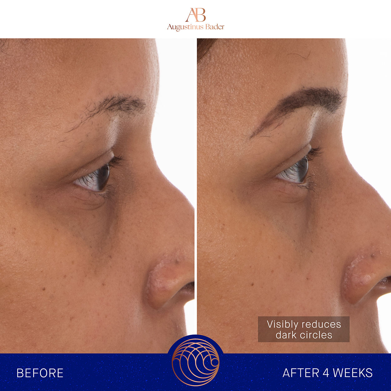 Before and after results of using Augustinus Bader The Eye Patches