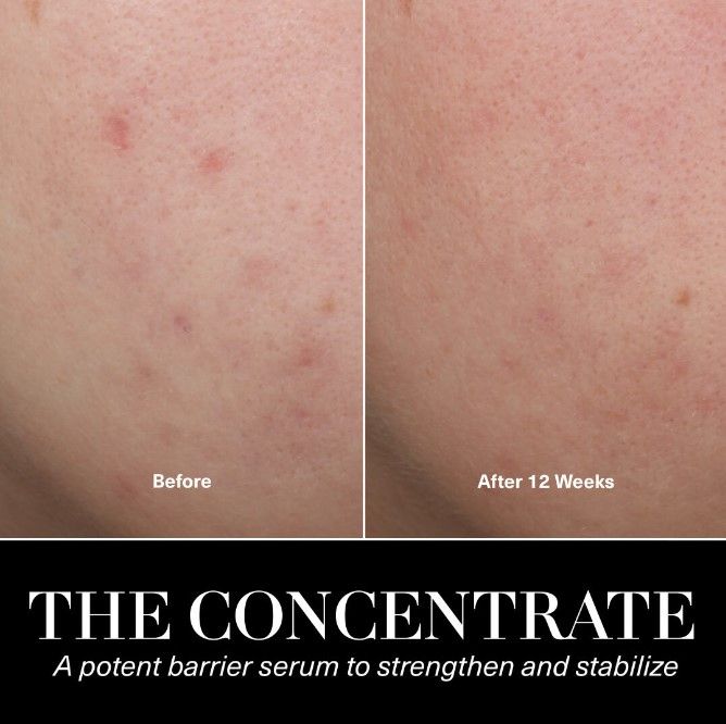 Before and after results of using La Mer The Concentrate