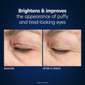 Before and after results of using PCA Skin Hyaluronic Acid Microneedle Eye Patches