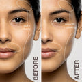 Before and after results of using Dermaflash Luxe+ variant: Blush