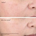 Before and after results of using Goop Beauty 15% Glycolic Acid Overnight Glow Peel