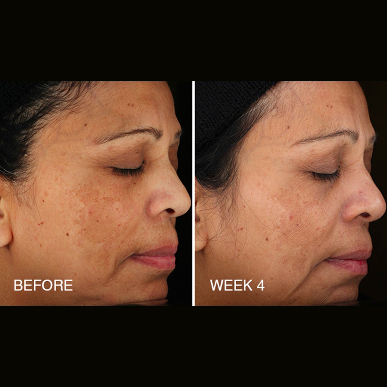 Before and after results of using BeautyStat Universal C Skin Refiner