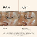Post Micro-Needling + Injection Bundle