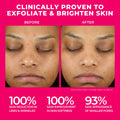 Before and after results of using BeautyStat Universal Triple Action Daily Peel with Glucosamine and AHAs/BHAs variant: 10 Treatments