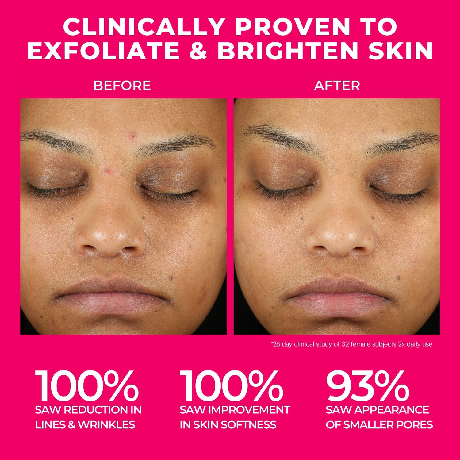 Before and after results of using BeautyStat Universal Triple Action Daily Peel with Glucosamine and AHAs/BHAs variant: 10 Treatments