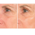 SIO Eye and Smile Lift Size variant: 2 Treatments before and after image .