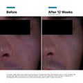 Before and after results of using  P-TIOX Cream variant: Default Title