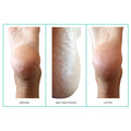 Patchology PoshPeel Pedi Cure Size variant: 1 Treatment before and after image .