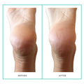Patchology PoshPeel Pedi Cure Size variant: 1 Treatment before and after image 2 .
