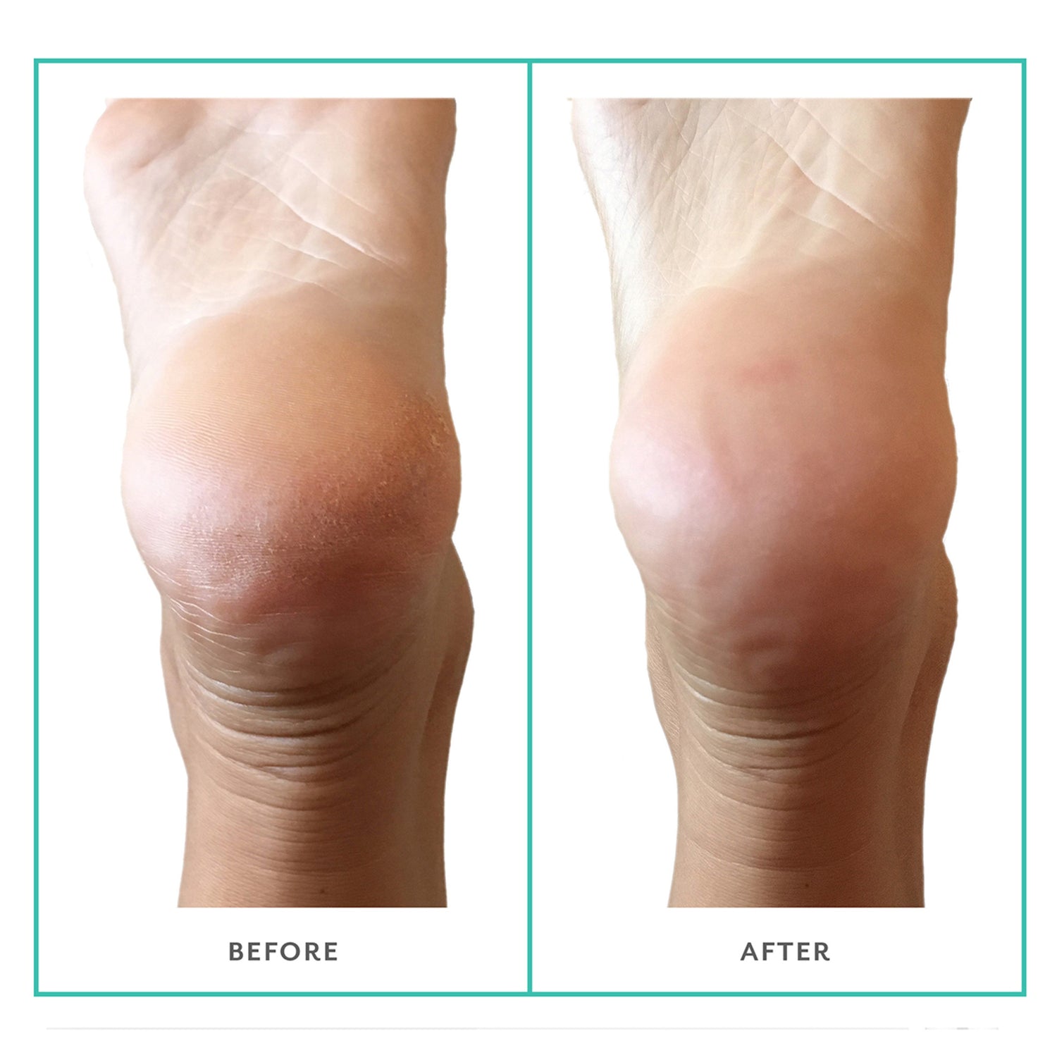 Patchology PoshPeel Pedi Cure Size variant: 1 Treatment before and after image 2 .